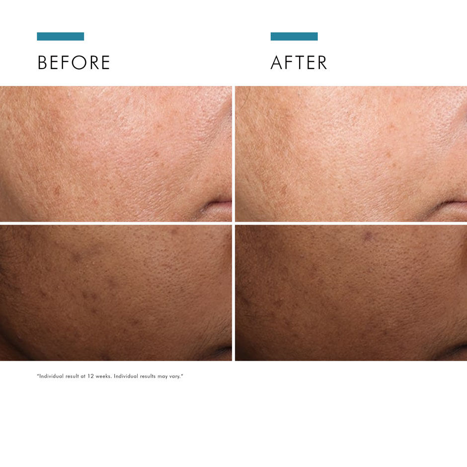 Discoloration Defense Serum