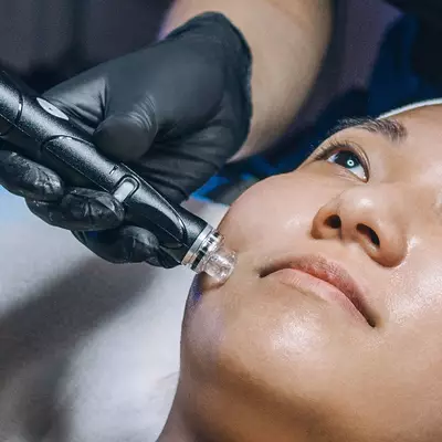 IPL Laser