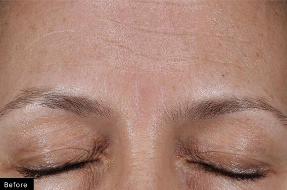 Avant un traitement esthetique, gros plan sur le front d'une personne aux yeux fermes, montrant des ridules et une peau lisse.