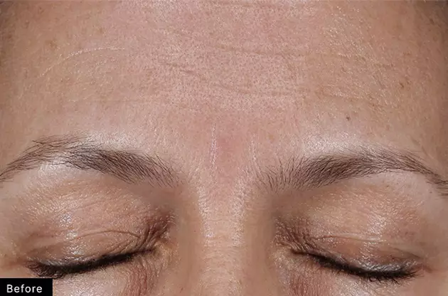 Avant un traitement esthetique, gros plan sur le front d'une personne aux yeux fermes, montrant des ridules et une peau lisse.