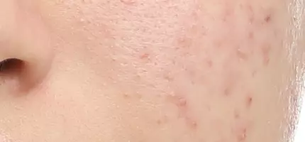 Close-up of a person's face showing skin with visible acne and texture variances.