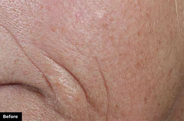 Close-up of skin showing fine lines and wrinkles, representing the 'before' state in a skincare treatment evaluation.