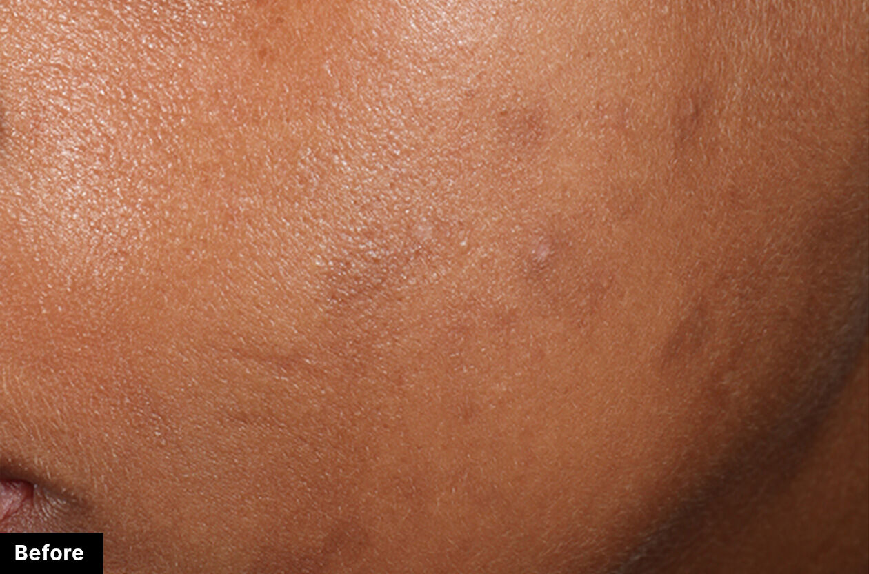 Peau avant traitement, montrant des irregularites et des taches sur la surface du visage.